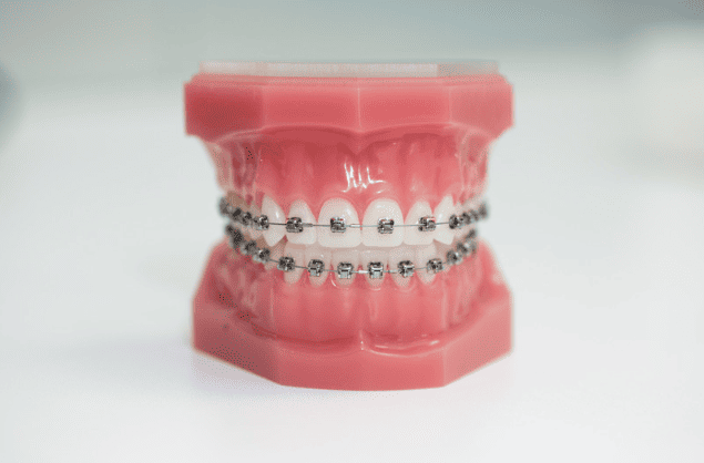 Braces Orthodontics 箍牙 牙齒矯正