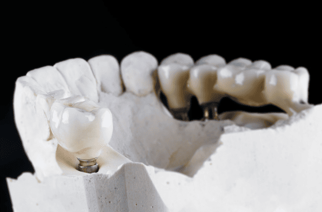 Dental Crowns & Bridges 牙冠及牙橋