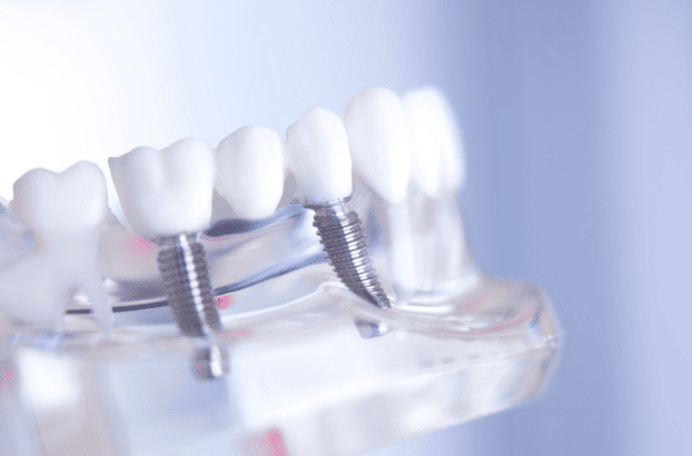 Dental Implants 種牙/植牙