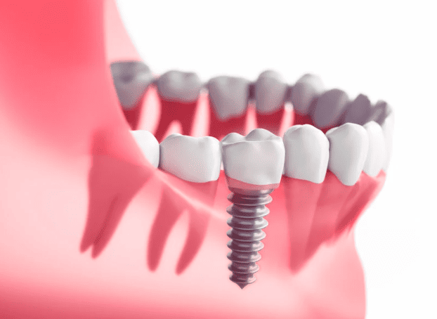 Dental Implants 種牙/植牙