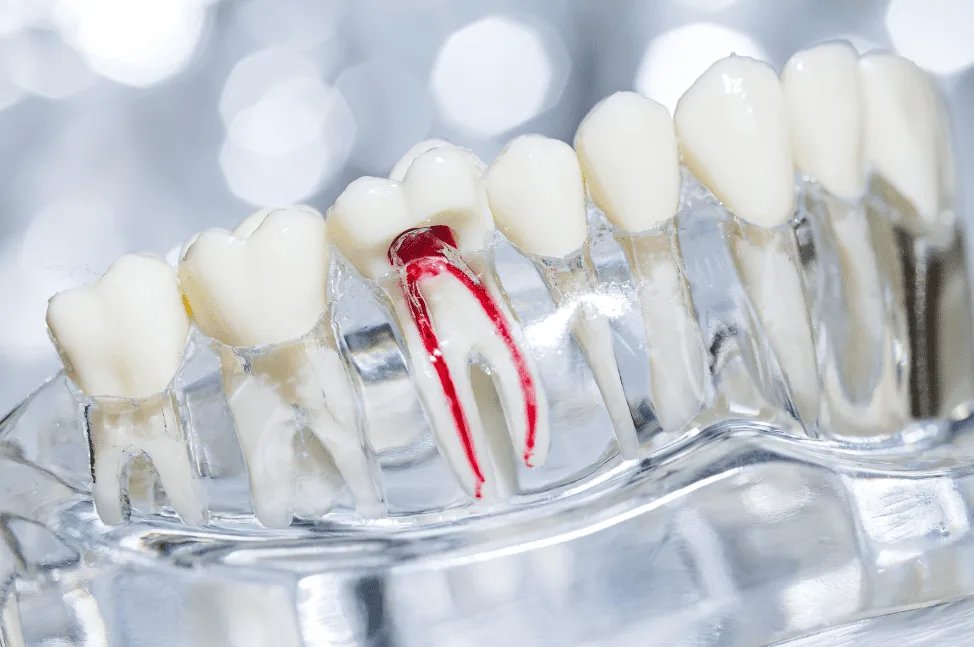 Guide to Root Canal Treatment 全面了解杜牙根治療 Guide to Root Canal Treatment 全面了解杜牙根治療
