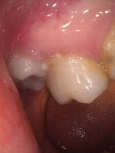 Infected or Inflamed Tooth Pulp 牙髓神經感染發炎 Infected or Inflamed Tooth Pulp 牙髓神經感染發炎