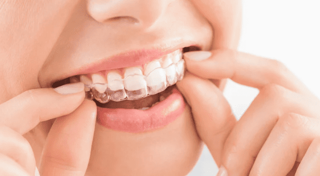 Invisalign 隱形牙箍