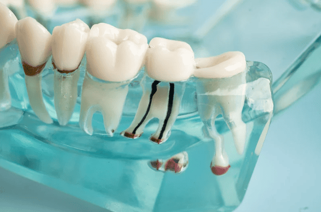 Root Canal Treatment 杜牙根 根管治療