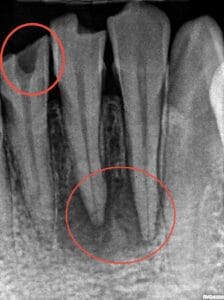 Tooth Damage 牙齒損壞 Tooth Damage 牙齒損壞