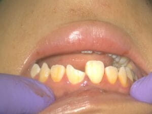 Tooth Damage 牙齒損壞 Tooth Damage 牙齒損壞