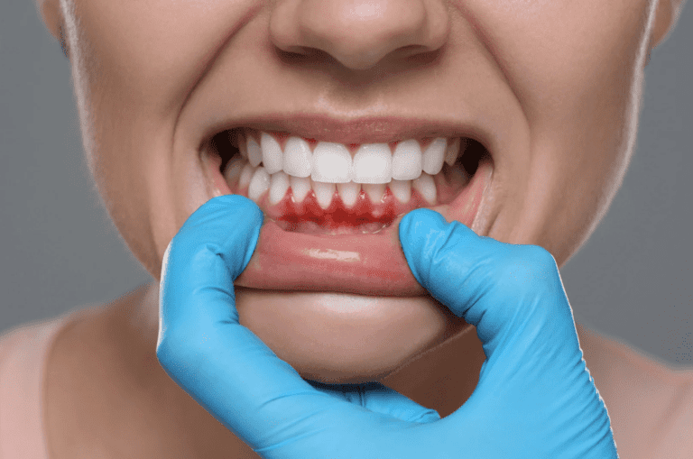 Dental Abscess 牙瘡