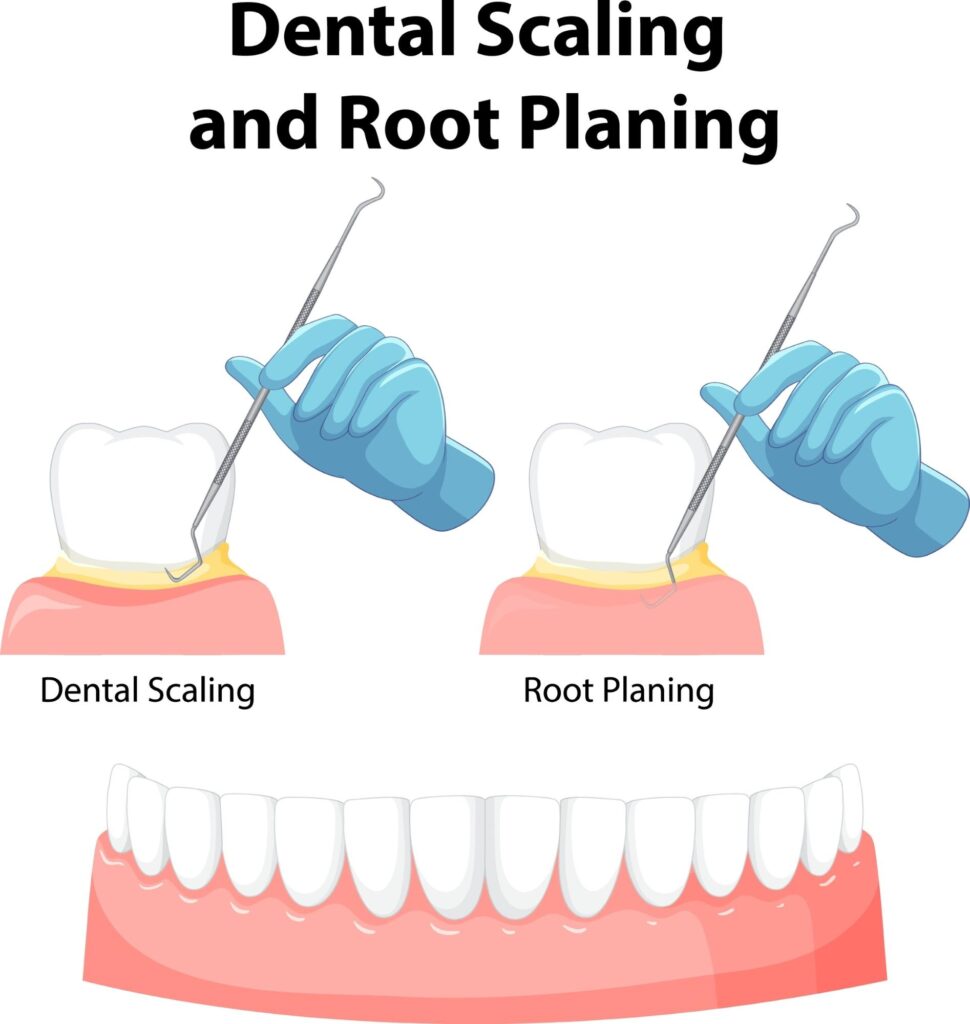 深層洗牙與牙根刮治 Scaling & Root Planing