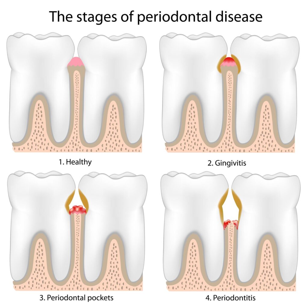 牙周病的發展階段 the stages of periodontal disease