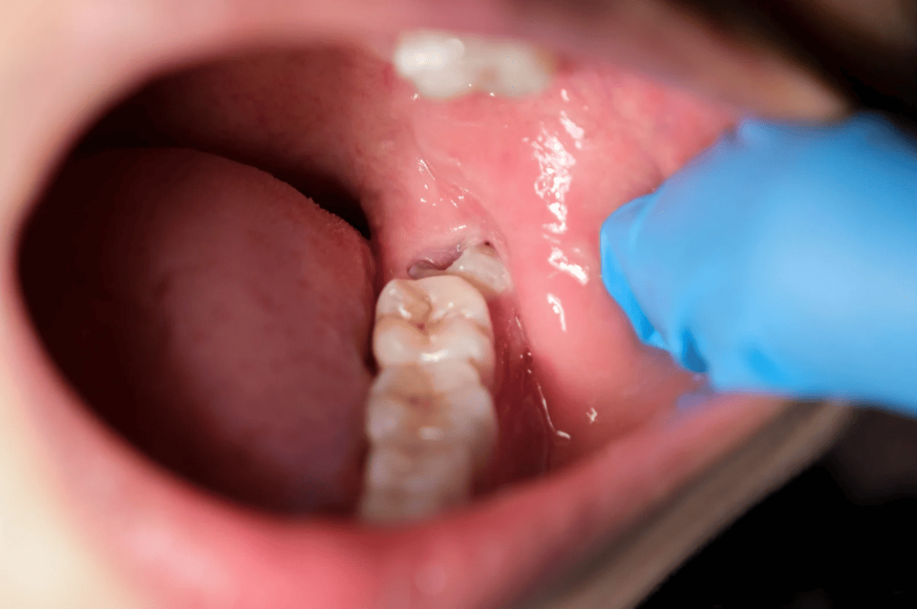 When Do Wisdom Teeth Grow 智慧齒幾時生