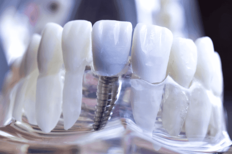 Dental Implant Guide 種牙植牙指南