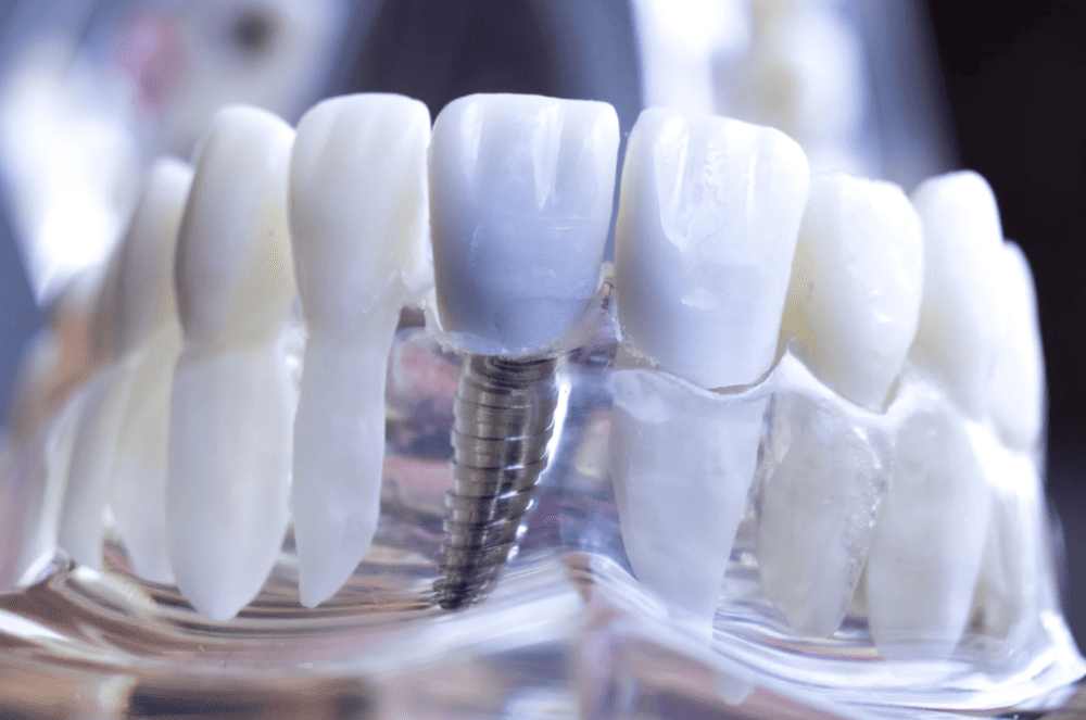 Dental Implant Guide 種牙植牙指南