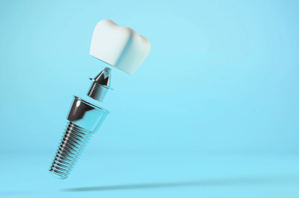 Dental Implant Procedure 種牙過程