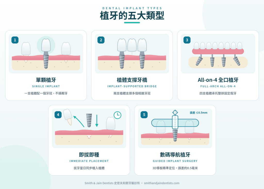 植牙類型比較：單顆植牙、植體牙橋、All-on-4、即拔即種及導航植牙