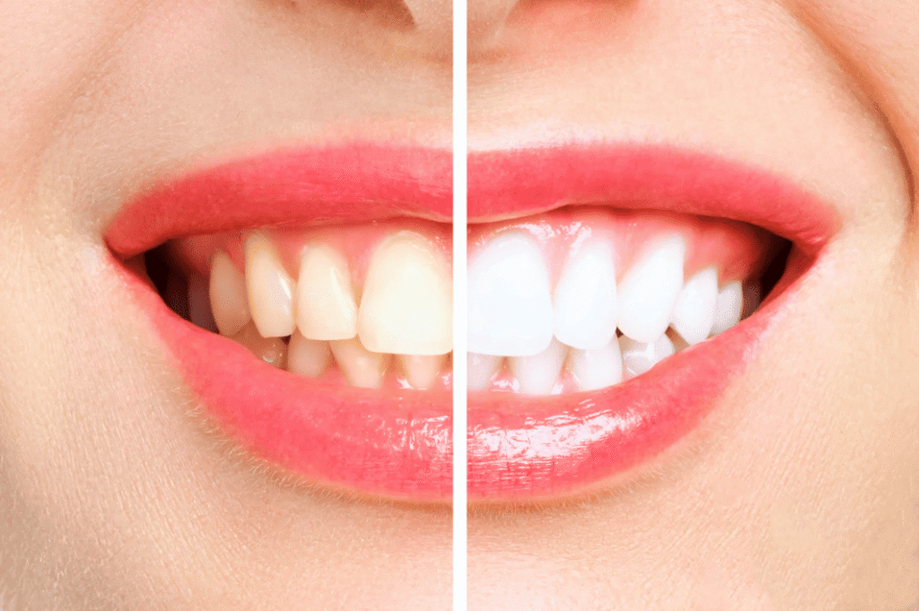 Teeth Whitening Precautions 牙齒美白注意事項
