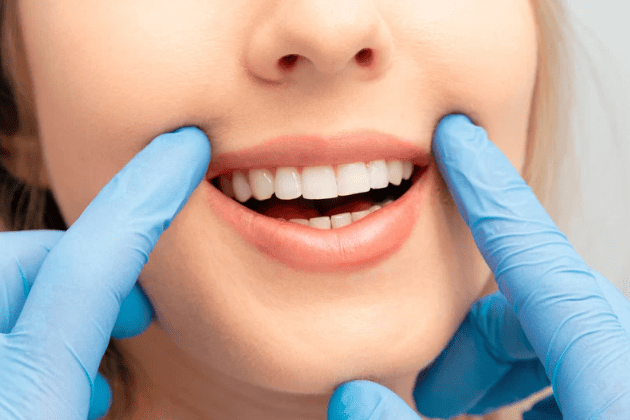 teeth whitening 美白牙齒