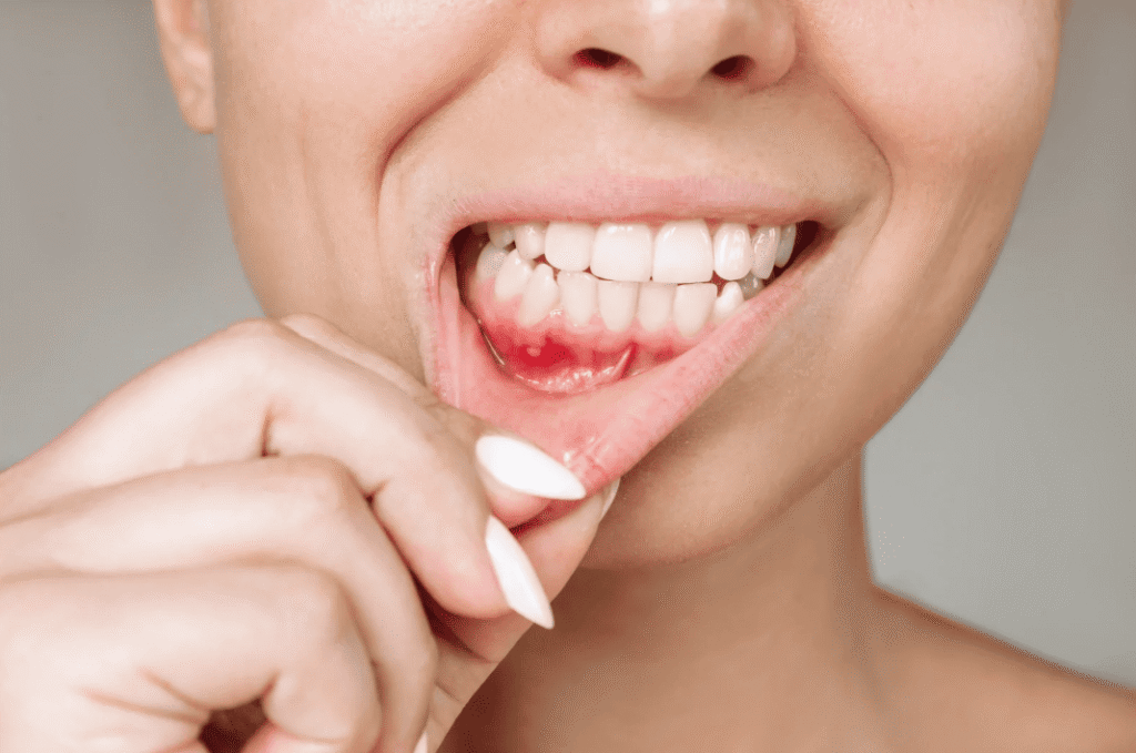 Mouth Ulcers Guide 口腔潰瘍指南