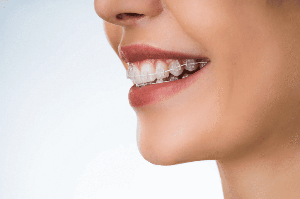 Overbite Treatment 倒及牙治療