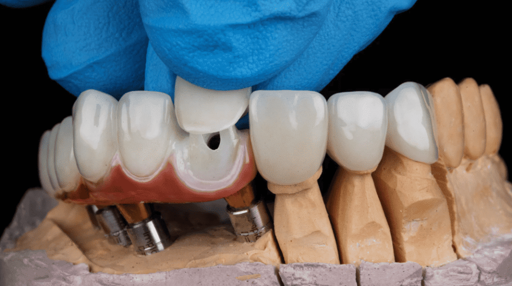 Root Canal Treatment Crown 杜牙根牙套的種類