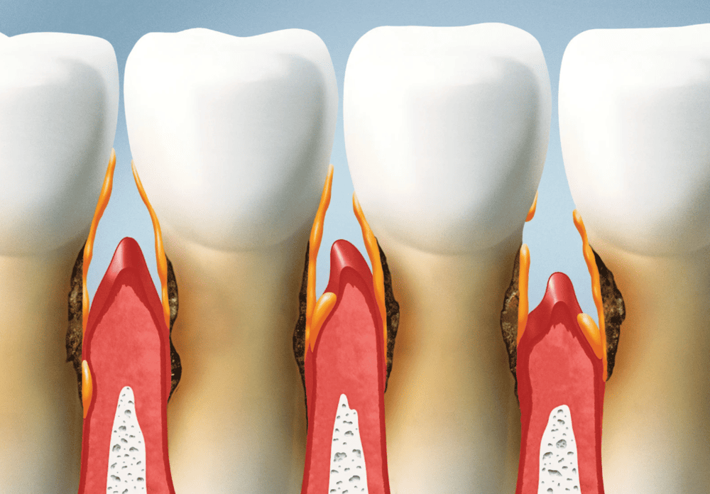 牙肉萎縮成因 gum recession causes