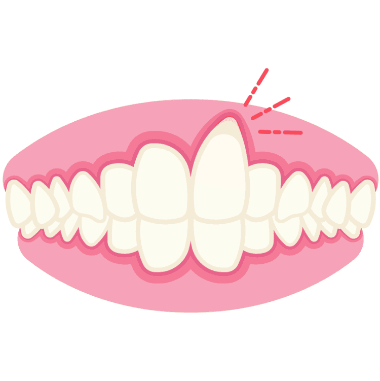 牙肉萎縮與年齡關係 gum recession age