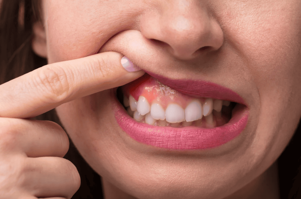 牙肉萎縮能否補救 Can gum recession be treated