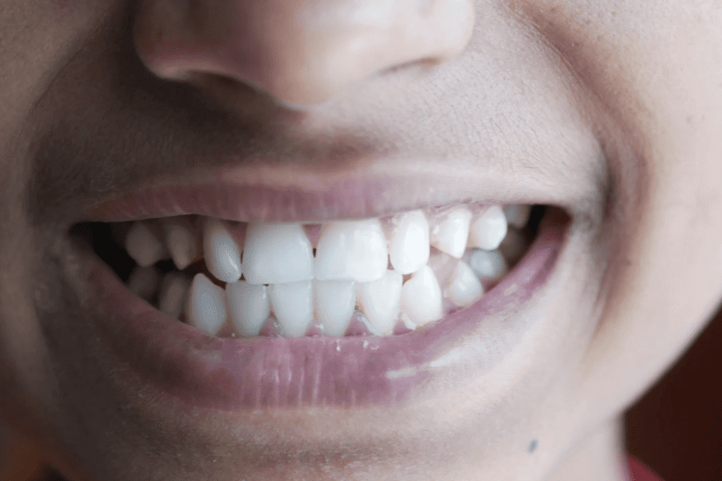 A Guide to Impacted Canine Teeth 阻生犬齒