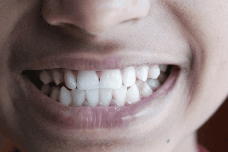 A Guide to Impacted Canine Teeth 阻生犬齒