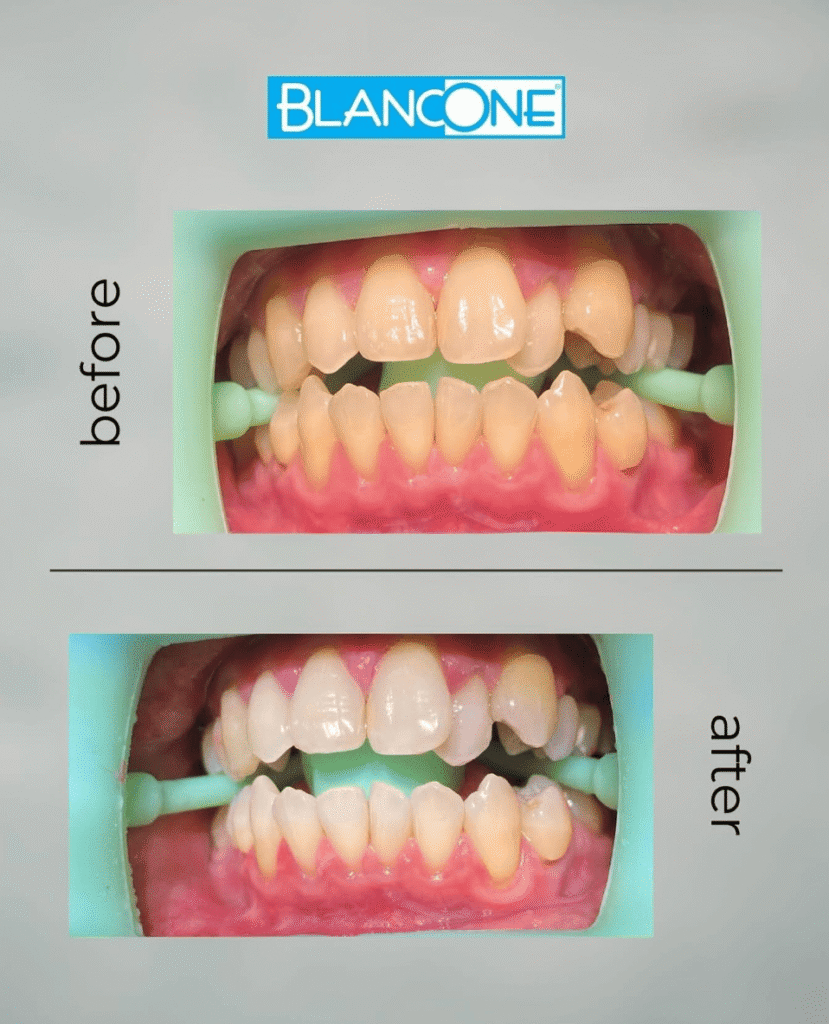 BlancOne Whitening before after effect BlancOne美白前後效果