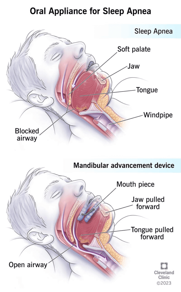 Why a Custom-Made MAD from a Dentist is the Gold Standard