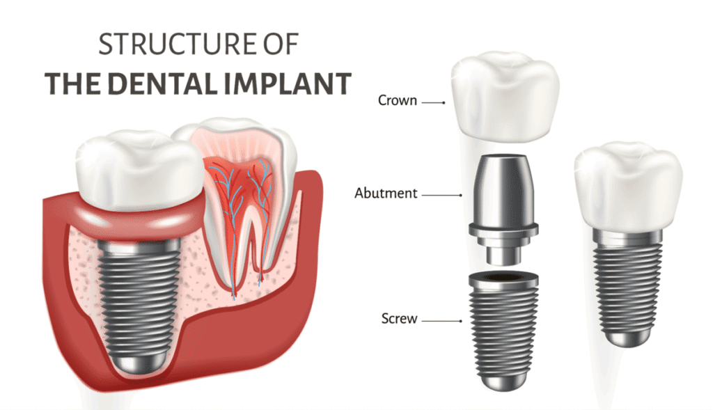 structure of the dental implants 種植牙結構