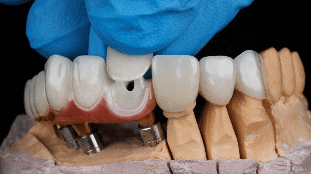 Dental Veneer Treatment Process 牙齒貼片療程步驟