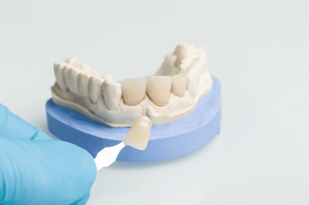 Dental Veneers 牙齒貼片 陶瓷貼片