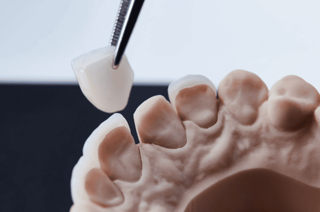 Potential Risks of Dental Veneers 牙齒貼片的潛在風險