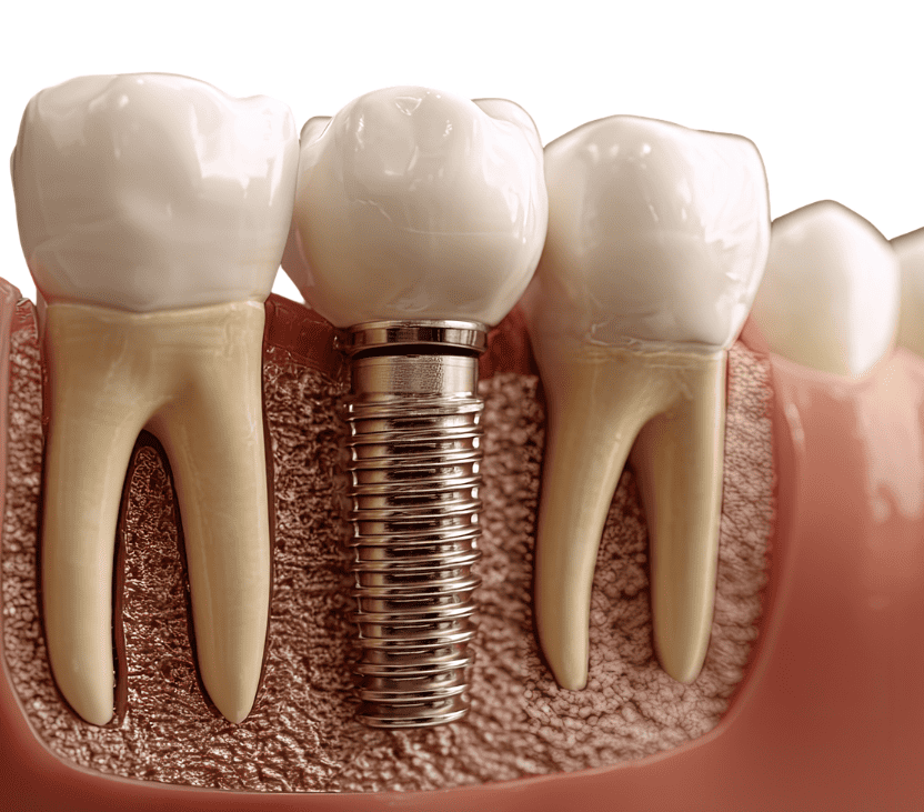 Dental implant price 植牙價錢