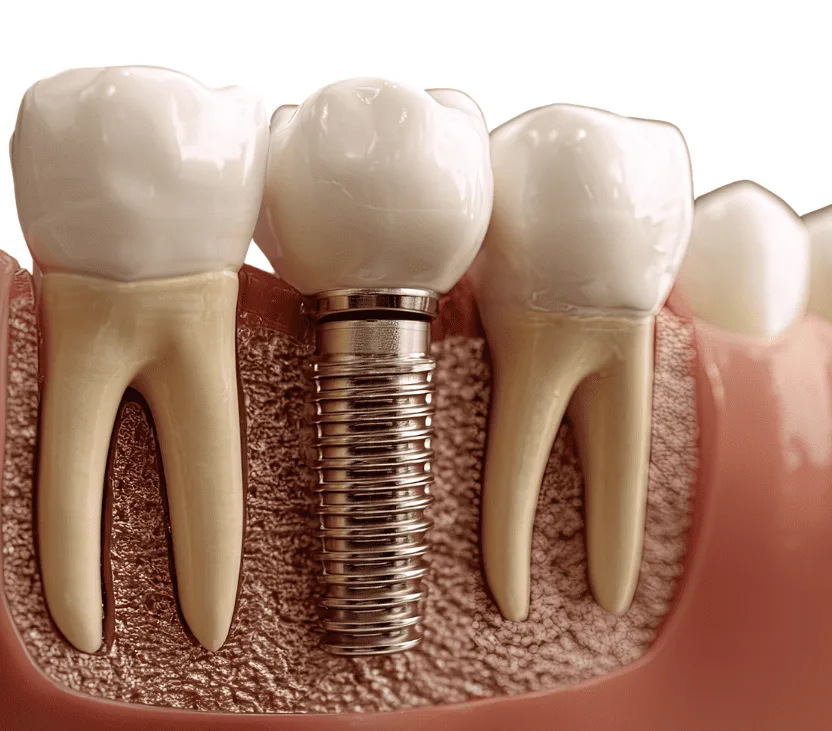 Dental implant price 植牙價錢